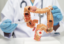 Tumore del colon retto, con immunoterapia 30% di remissioni complete tumore del colon retto studio Impact CRC