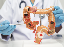 Tumore del colon retto, con immunoterapia 30% di remissioni complete tumore del colon retto studio Impact CRC