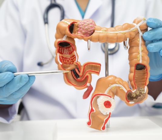 Tumore del colon retto, con immunoterapia 30% di remissioni complete tumore del colon retto studio Impact CRC