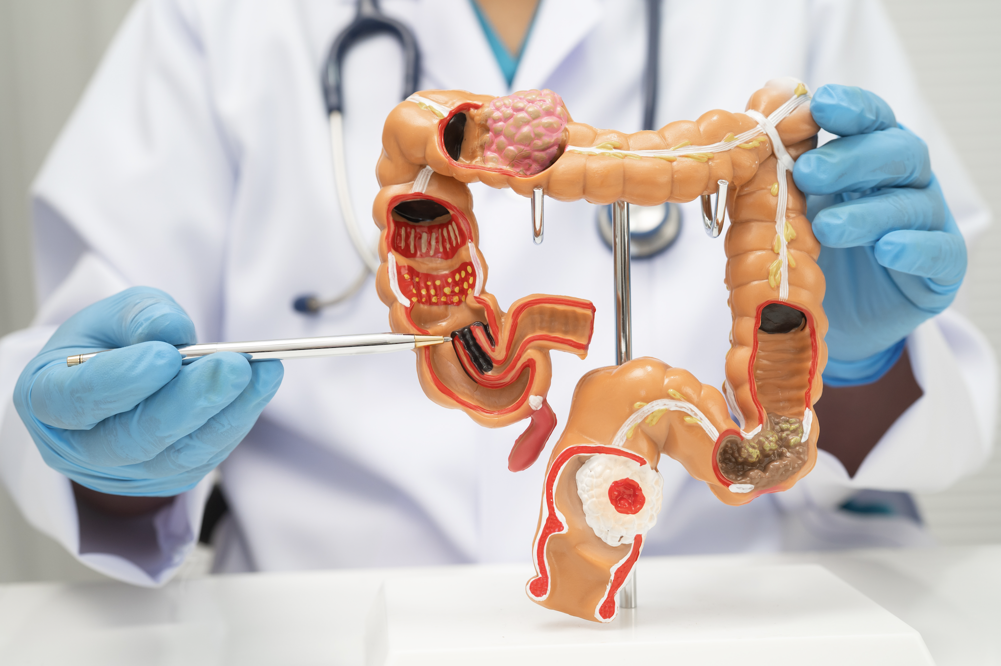 Tumore del colon retto, con immunoterapia 30% di remissioni complete