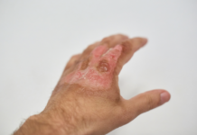 Gel inettabile per la cura di ustioni e ferite gravi pelle in siringa per ustioni e ferite gravi