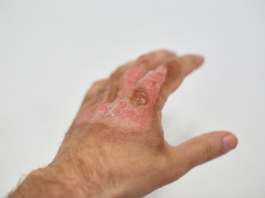 Gel inettabile per la cura di ustioni e ferite gravi pelle in siringa per ustioni e ferite gravi