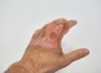 Gel inettabile per la cura di ustioni e ferite gravi pelle in siringa per ustioni e ferite gravi