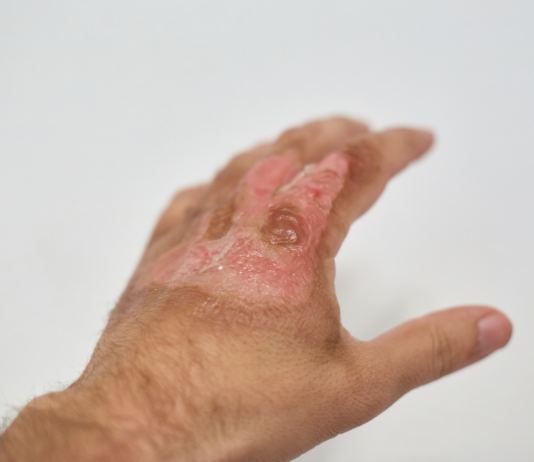 Gel inettabile per la cura di ustioni e ferite gravi pelle in siringa per ustioni e ferite gravi