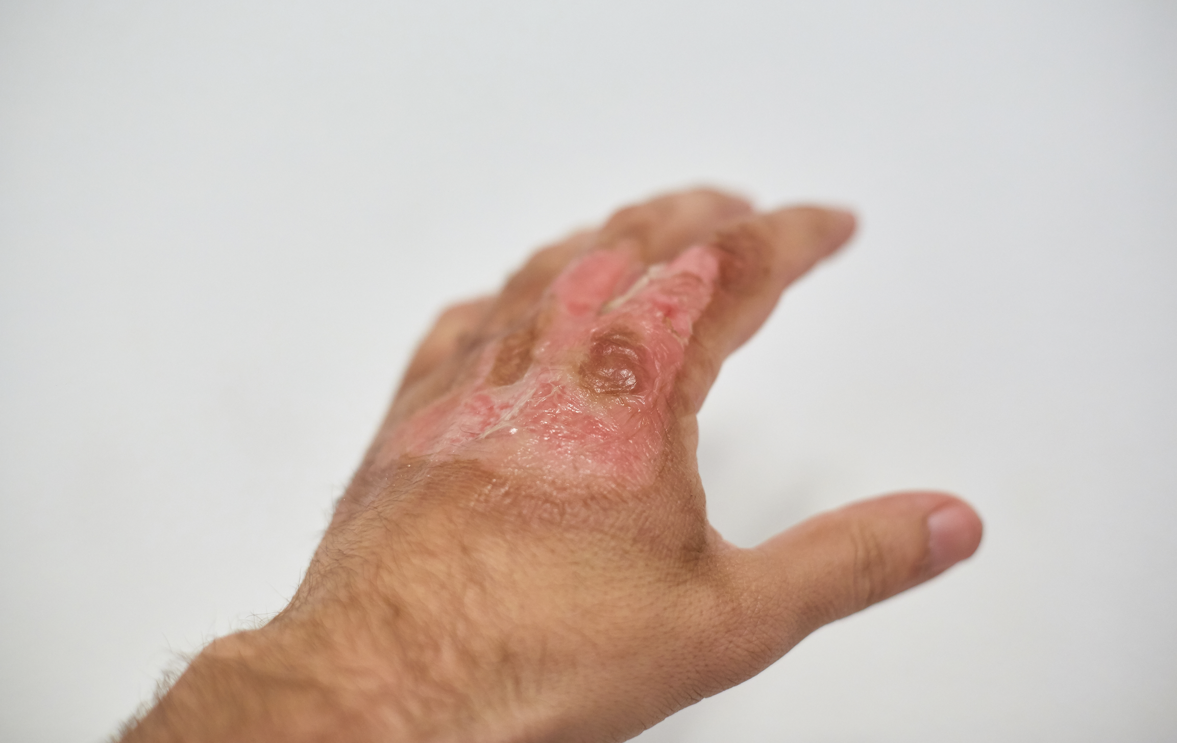 Gel inettabile per la cura di ustioni e ferite gravi