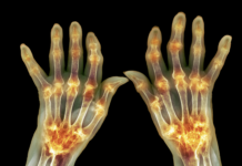 Artrite reumatoide: nanoparticelle per ridurre le riacutizzazioni artrite reumatoide nanoparticelle