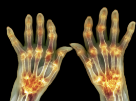 Artrite reumatoide: nanoparticelle per ridurre le riacutizzazioni artrite reumatoide nanoparticelle