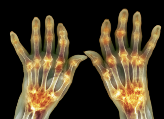 Artrite reumatoide: nanoparticelle per ridurre le riacutizzazioni artrite reumatoide nanoparticelle