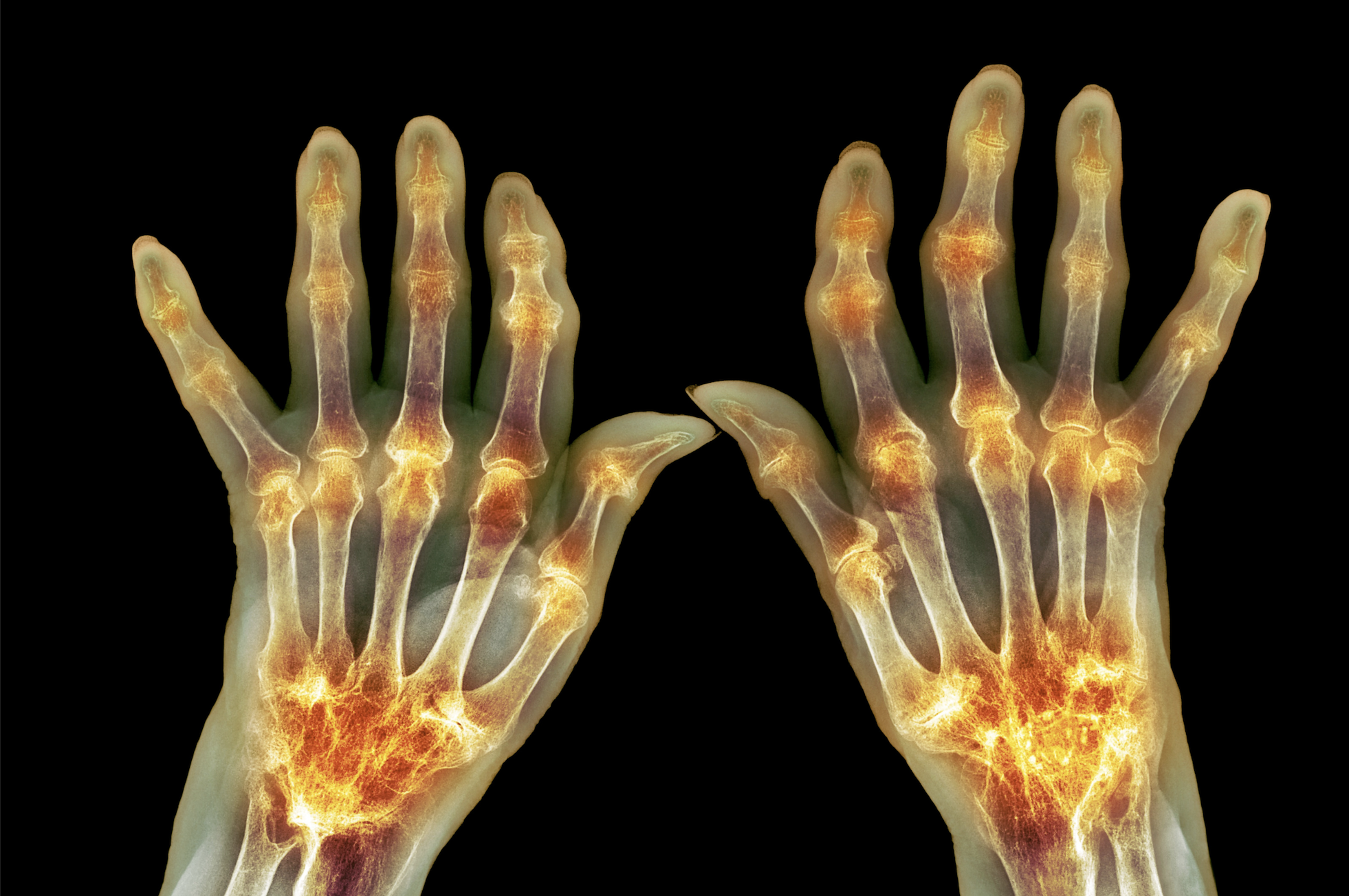 Artrite reumatoide: nanoparticelle per ridurre le riacutizzazioni