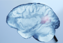 Recupero post ictus, ruolo dell’emisfero cerebrale opposto alla lesione recupero post ictus studio Irccs Neuromed