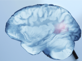 Recupero post ictus, ruolo dell’emisfero cerebrale opposto alla lesione recupero post ictus studio Irccs Neuromed