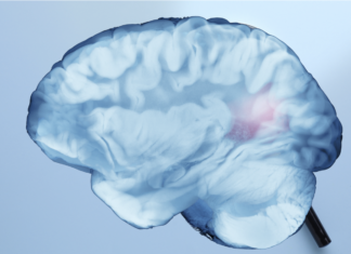 Recupero post ictus, ruolo dell’emisfero cerebrale opposto alla lesione recupero post ictus studio Irccs Neuromed