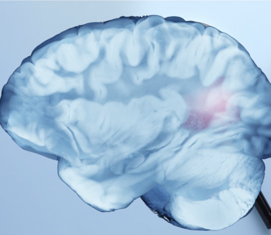 Recupero post ictus, ruolo dell’emisfero cerebrale opposto alla lesione recupero post ictus studio Irccs Neuromed