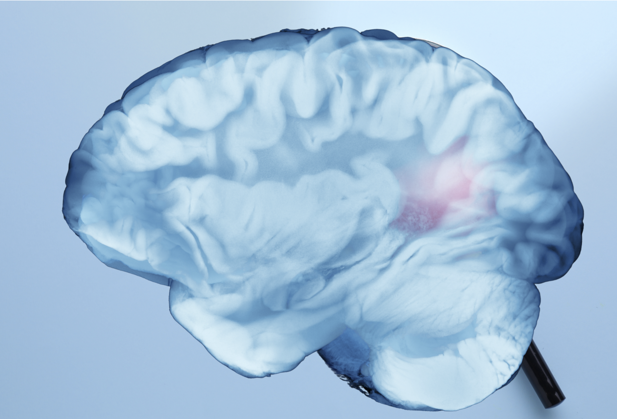 Recupero post ictus, ruolo dell’emisfero cerebrale opposto alla lesione