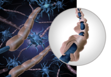 La lotta alla sclerosi multipla riparte da Regione Lombardia sclerosi multipla Pdta Agenas Regione Lombardia