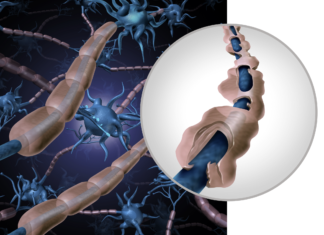 La lotta alla sclerosi multipla riparte da Regione Lombardia sclerosi multipla Pdta Agenas Regione Lombardia