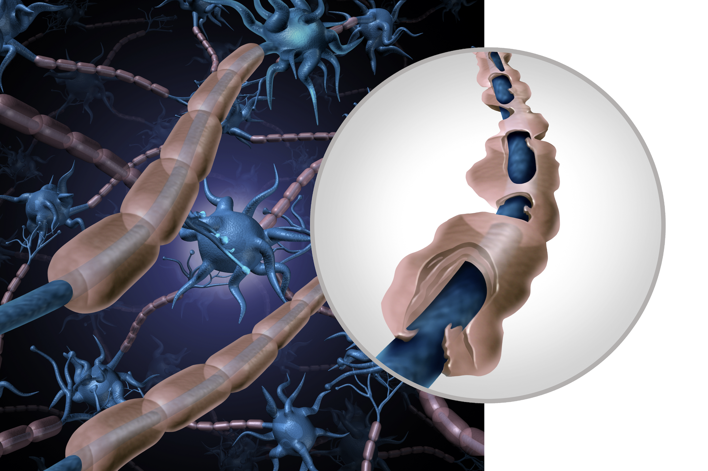 La lotta alla sclerosi multipla riparte da Regione Lombardia