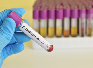 Beta-talassemia in Italia, verso una strategia nazionale integrata betatassemia