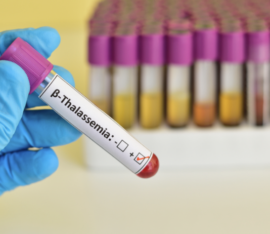 Beta-talassemia in Italia, verso una strategia nazionale integrata betatassemia