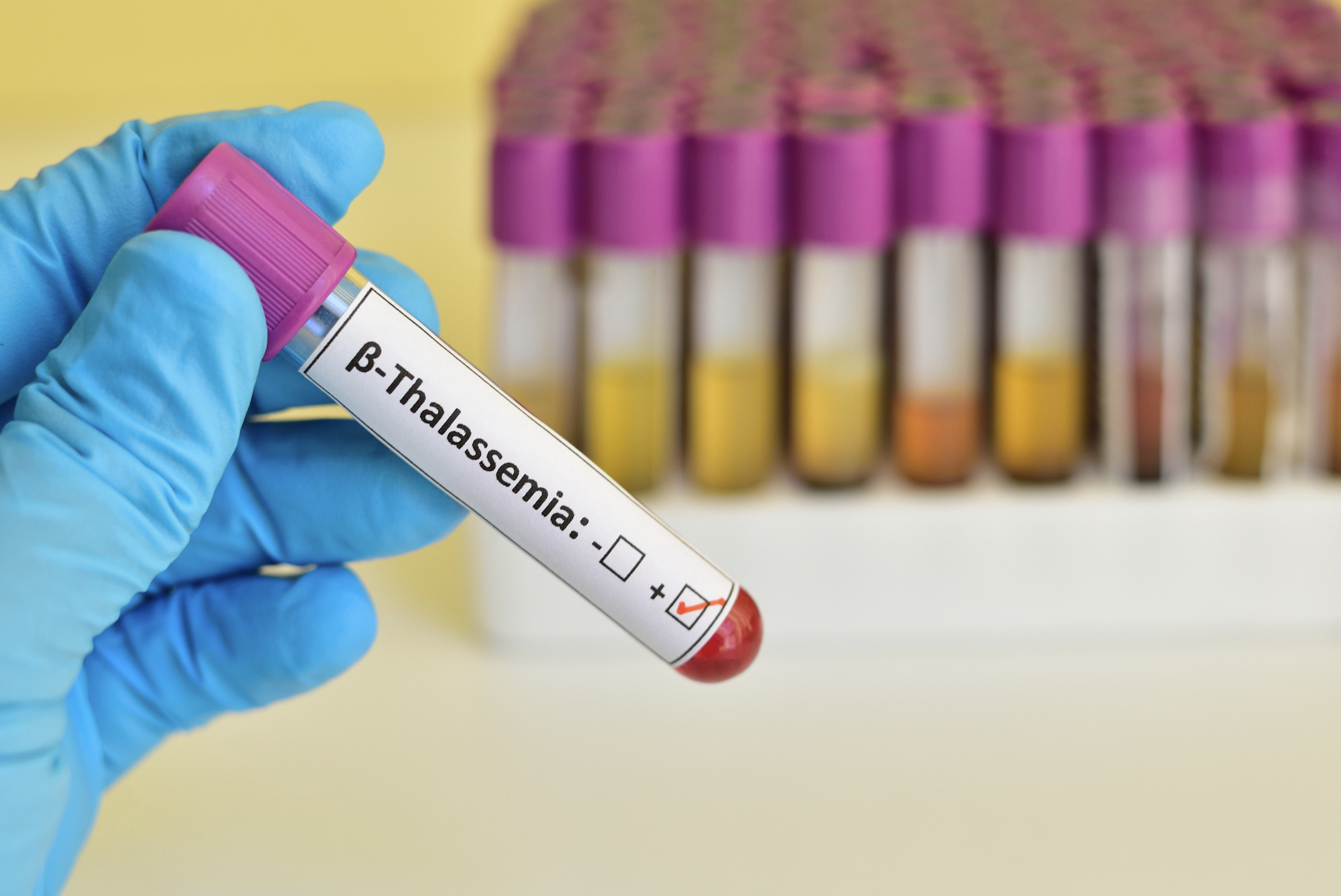 Beta-talassemia in Italia, verso una strategia nazionale integrata