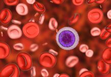 Leucemia pediatrica: verso terapia mirata per sottogruppo con alterazione del gene PAX5