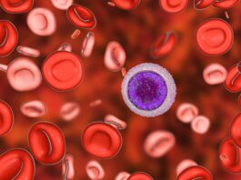 Leucemia pediatrica: verso terapia mirata per sottogruppo con alterazione del gene PAX5