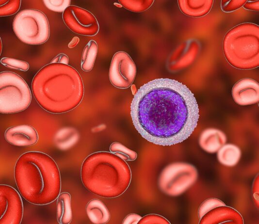 Leucemia pediatrica: verso terapia mirata per sottogruppo con alterazione del gene PAX5