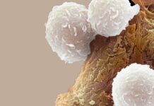 Leucemia pediatrica: l’immunoterapia dimezza le recidive