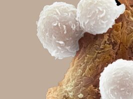 Leucemia pediatrica: l’immunoterapia dimezza le recidive