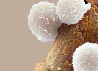 Leucemia pediatrica: l’immunoterapia dimezza le recidive