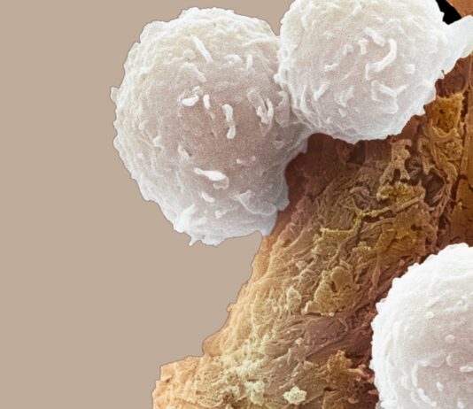 Leucemia pediatrica: l’immunoterapia dimezza le recidive