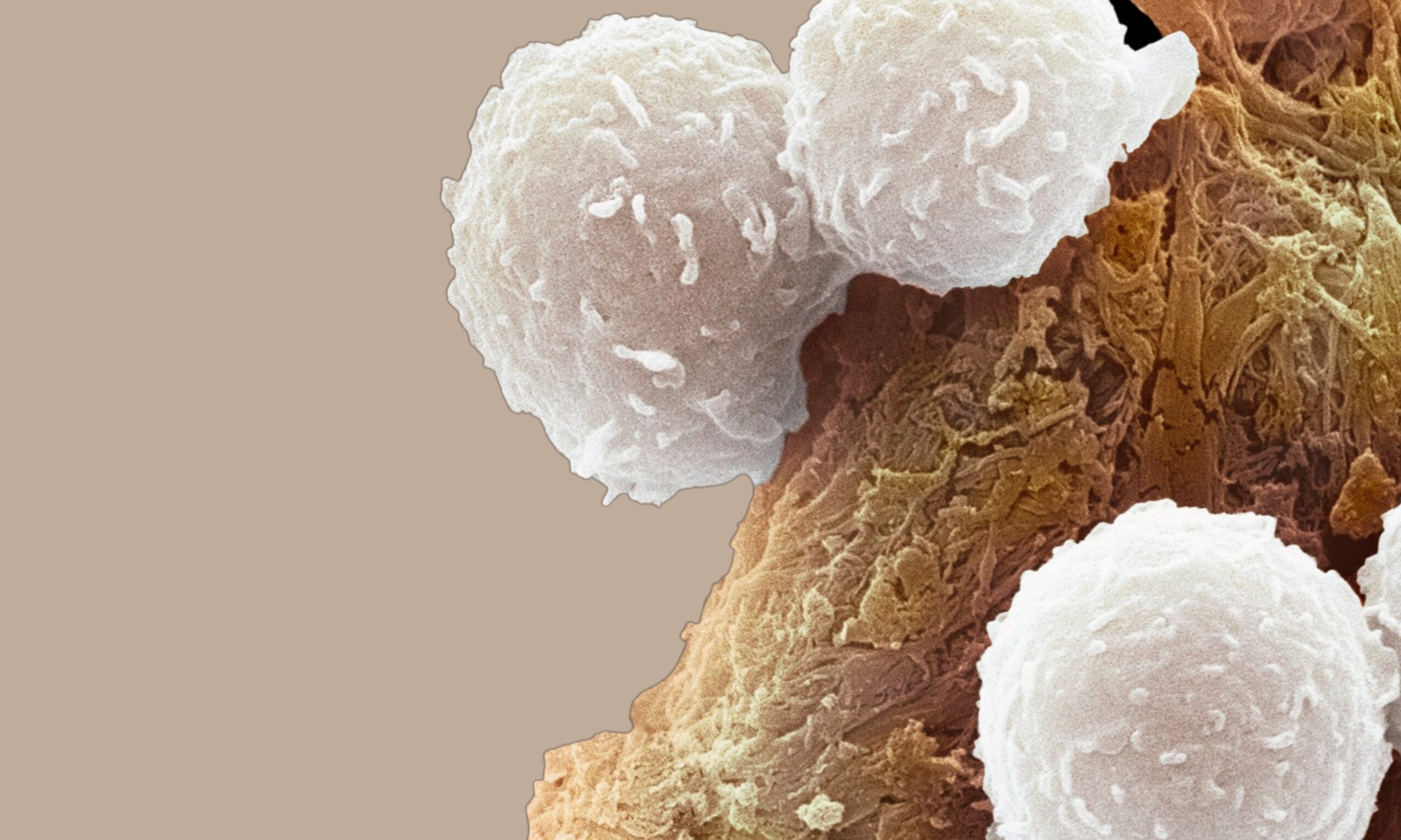 Leucemia pediatrica: l’immunoterapia dimezza le recidive