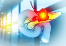 Tumore del pancreas: la variante genetica che ne influenza l’aggressività