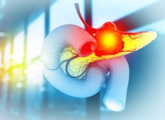 Tumore del pancreas: la variante genetica che ne influenza l’aggressività