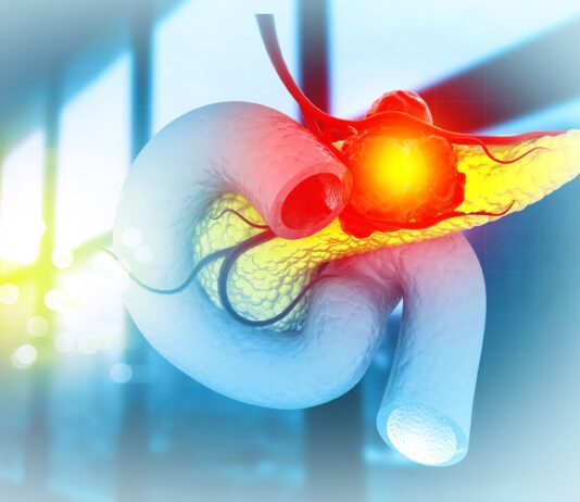 Tumore del pancreas: la variante genetica che ne influenza l’aggressività