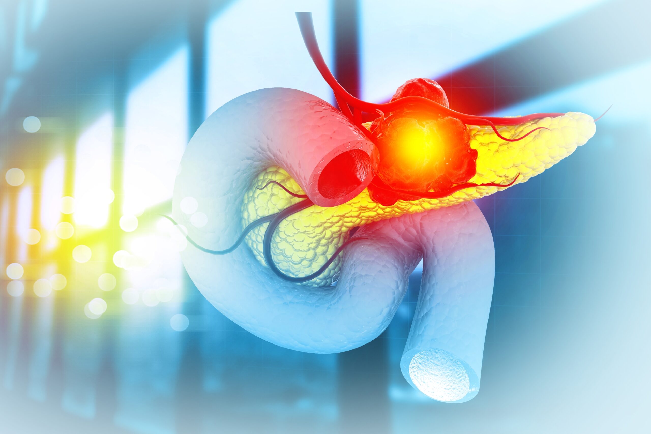 Tumore del pancreas: la variante genetica che ne influenza l’aggressività