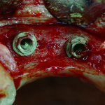 Prevenzione e trattamento dell’atrofia ossea a fini implantari: una serie di casi clinici