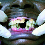 Problematiche odontoiatriche nel terzo mondo: epidemiologia, prevenzione e terapia in Kenya