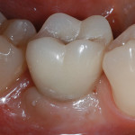 Corone singole su impianti a connessione conometrica nei settori posteriori dei mascellari: carico dilazionato contro carico immediato. Studio prospettico, controllato e randomizzato