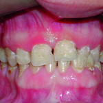 Sindrome da Iper-IgE: una patologia sistemica con importanti implicazioni odontostomatologiche