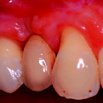 Rigenerazione ossea localizzata con osso suino: evidenze cliniche e istologiche