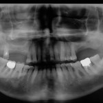 Rialzo del seno mascellare e impianti endossei. Risultati clinici a distanza di tempo e proposta di classificazione dei difetti iniziali del mascellare superiore atrofico