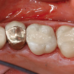 Valutazione clinica di un nuovo materiale per ricostruzioni dentali a lungo termine. Dati preliminari di uno studio prospettico