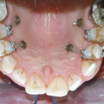 Utilizzo delle miniviti ortodontiche in un caso di riabilitazione implanto-protesica a carico immediato