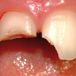 5. Traumatologia dentale: aspetti endodontici in dentatura permanente