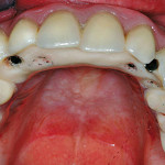 La riabilitazione del paziente edentulo con funzione immediata: opzioni terapeutiche. Valutazione retrospettiva di 22 casi