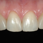 Riabilitazione conservativa del sorriso