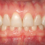 L’uso del composito in casi di grave abrasione ed erosione: caso clinico