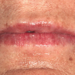 Riabilitazione con approccio multidisciplinare Caso clinico