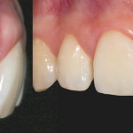 6. Restauro adesivo indiretto di un incisivo centrale: approccio clinico step by step